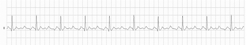 Atrial Flutter Rhythm Strip